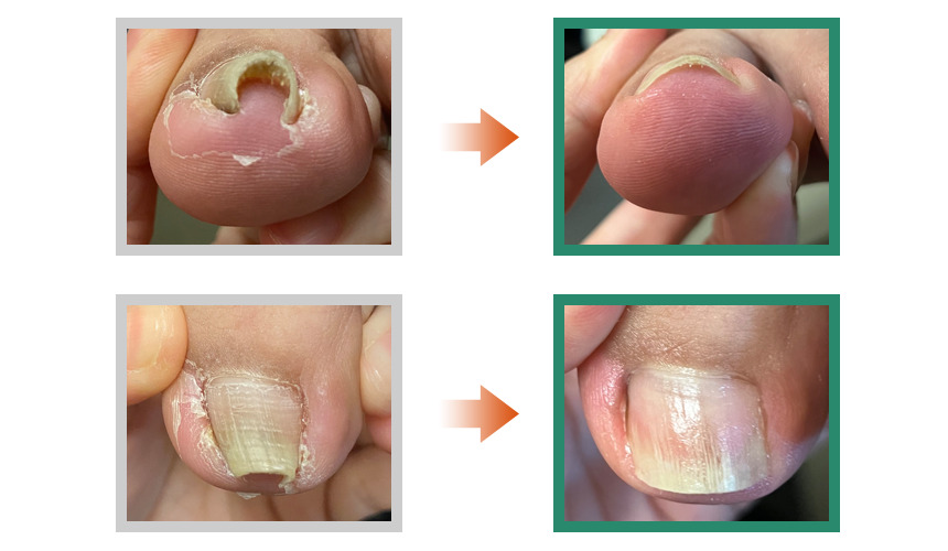 巻き爪,広島,安佐南区,大町東,陥入爪