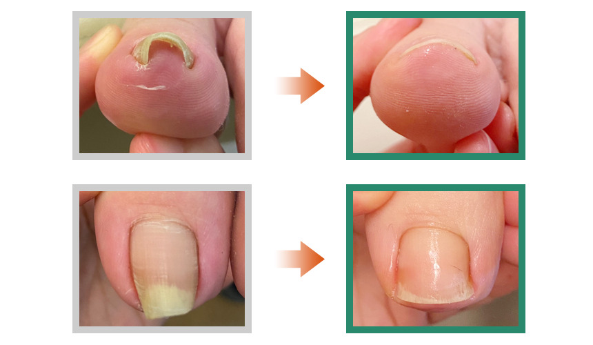巻き爪,広島,安佐南区,大町東,陥入爪